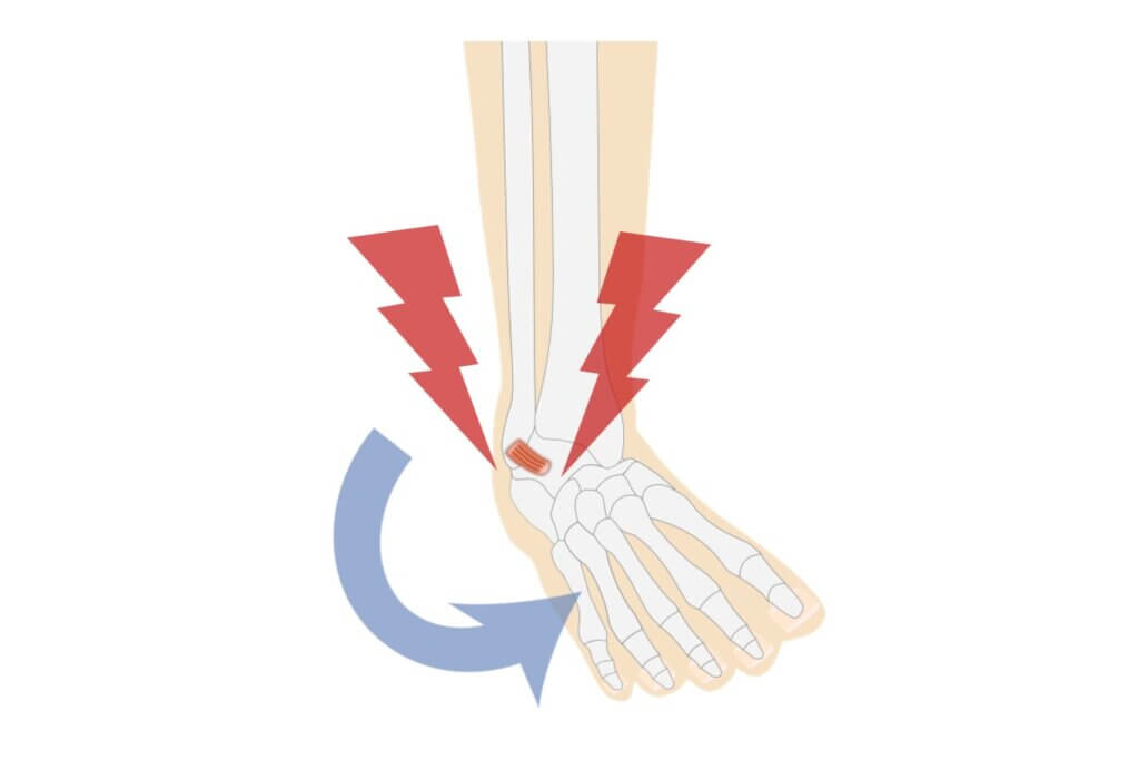 足首の捻挫（ひねって）で前距腓靭帯を痛める