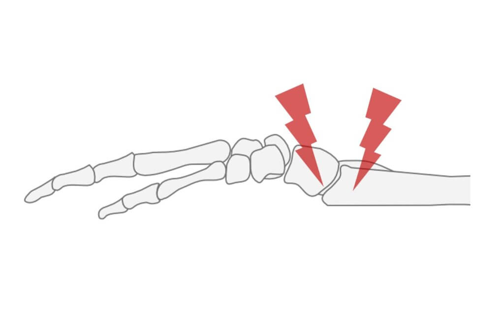 右手首の骨折