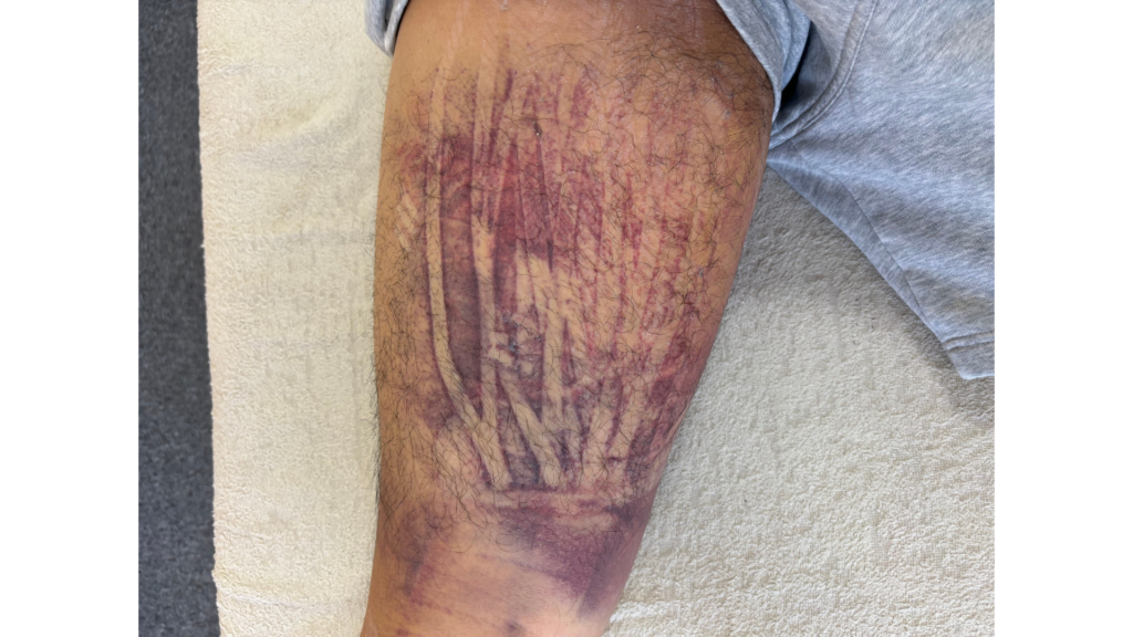 受傷5日目のハムストリングの肉離れ