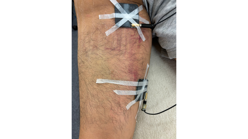 治ってきたハムストリング